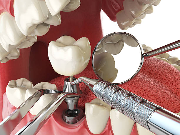 Best Emergency Treatment for Oral Infections in Attica, MI